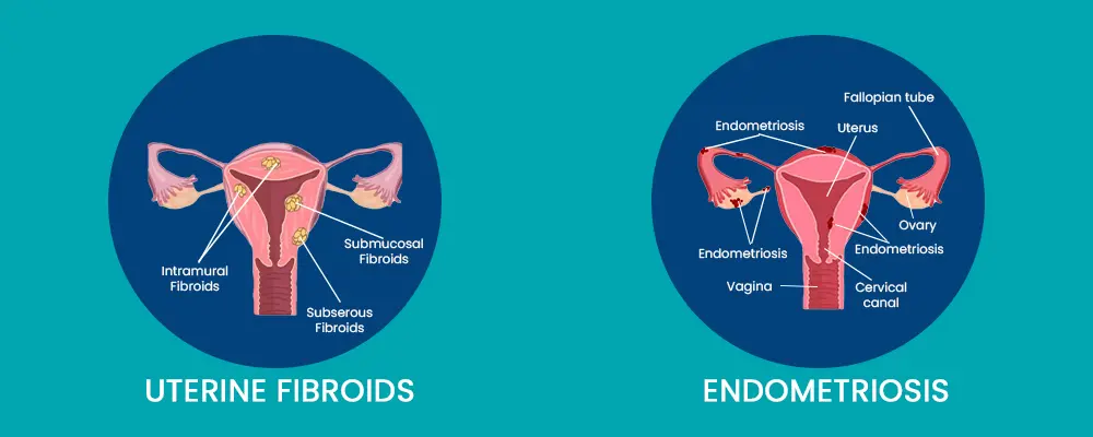 Fibroids and Endometriosis Clinic In Jaipur