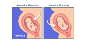 Anterior vs Posterior Placenta | Dr. Asha Susawat
