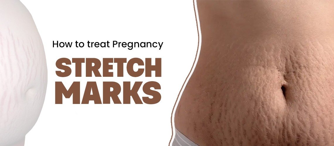 How to treat Pregnancy Stretch marks